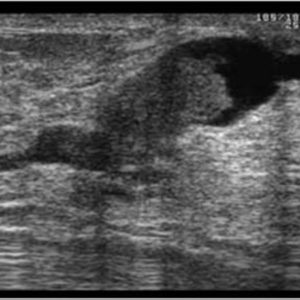 U nhú ống tuyến