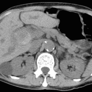 Giả phình ĐM gan