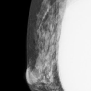 Vỡ túi nâng ngực