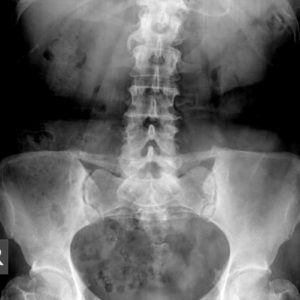 Vôi hóa dây chằng