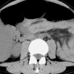 Thai ngoài tử cung