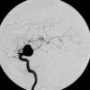 Phình ĐM não - Hình ảnh 5