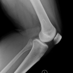 Chấn thương xương khớp