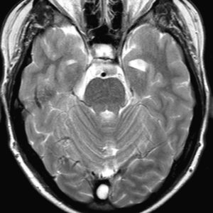 Nang xoang tĩnh mạch