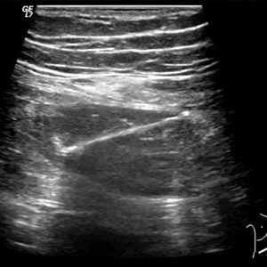 Dị vật ống tiêu hóa