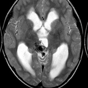 Thông động tĩnh mạch não