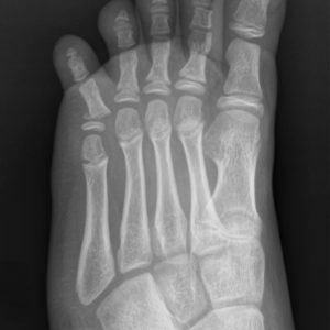 Chấn thương bàn chân