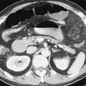 Nhồi máu mạc nối