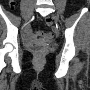 Rò niệu quản - âm đạo