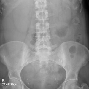 Rò niệu quản - âm đạo