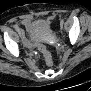 Rò niệu quản - bàng quang