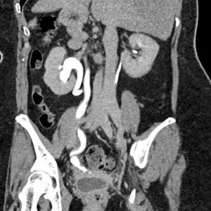 Rò niệu quản - âm đạo