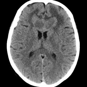 Lymphoma