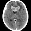 Lymphoma - Hình ảnh 2