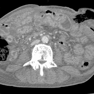 Sa hậu môn nhân tạo