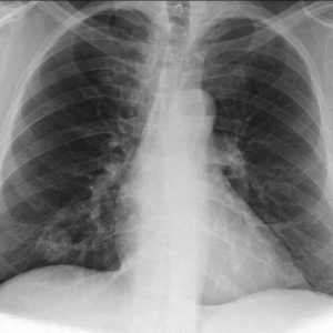 U phổi