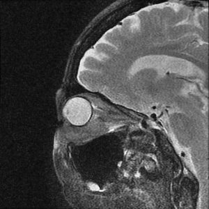 Lymphoma hốc mắt