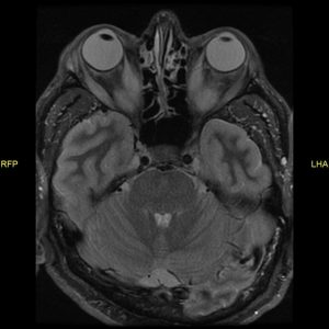Bệnh mắt tuyến giáp