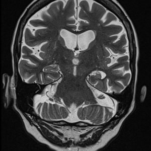 Xơ hóa  hồi hải mã