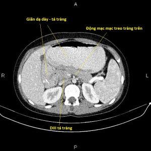 Hội chứng Wilkie