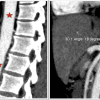 Giảm góc mở giữa ĐM mạc treo tràng trên & ĐM chủ bụng