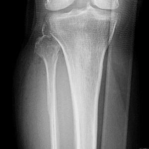 Chấn thương khớp gối