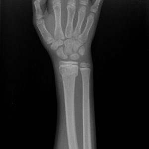 Chấn thương cẳng tay