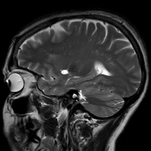 Rộng khoang quanh mạch