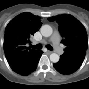 Phình ĐM phế quản