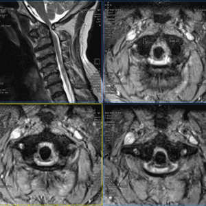 Chấn thương cột sống cổ