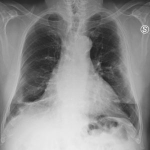 Viêm phổi Covid-19