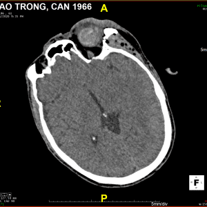 Chấn thương nhãn cầu