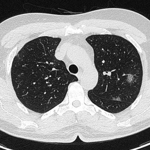 Viêm phổi Covid-19