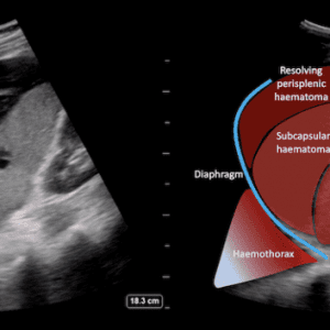 Chấn thương lách