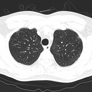 Viêm phổi Covid-19