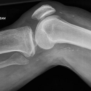 Chấn thương khớp gối