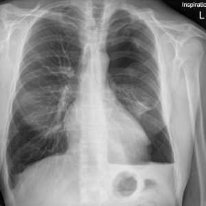 Dịch khí màng phổi