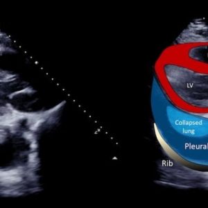 Tràn dịch màng phổi