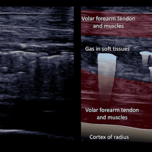 Hoại tử phần mềm