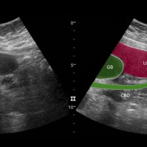 Sỏi ống mật chủ