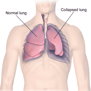 Tràn khí màng phổi