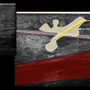 Dị vật phần mềm