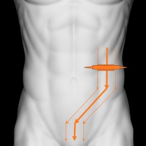 Viêm túi thừa đại tràng