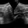 Schwannoma - Ảnh 2