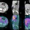 Schwannoma - Ảnh 3