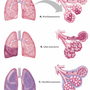 Siêu âm viêm phổi
