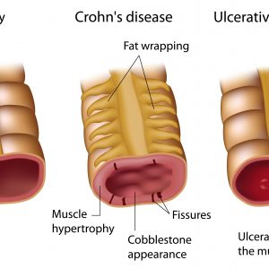 Viêm ruột - Crohn
