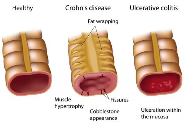 Viêm ruột - Crohn