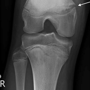 Gãy xương mệt mỏi