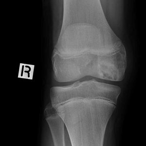 Viêm xương sụn bóc tách